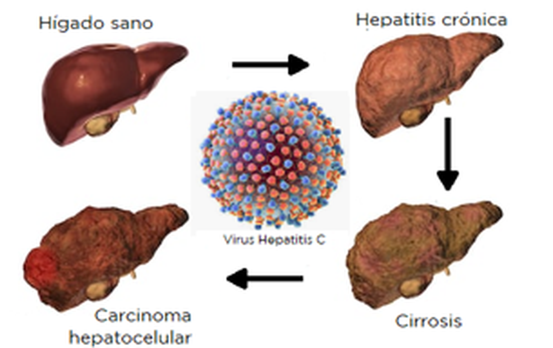 Progreso de la hepatitis C