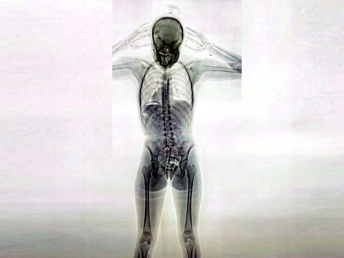 La radiografía de la mula detenida en Ezeiza con la panza repleta de cápsulas de cocaína.