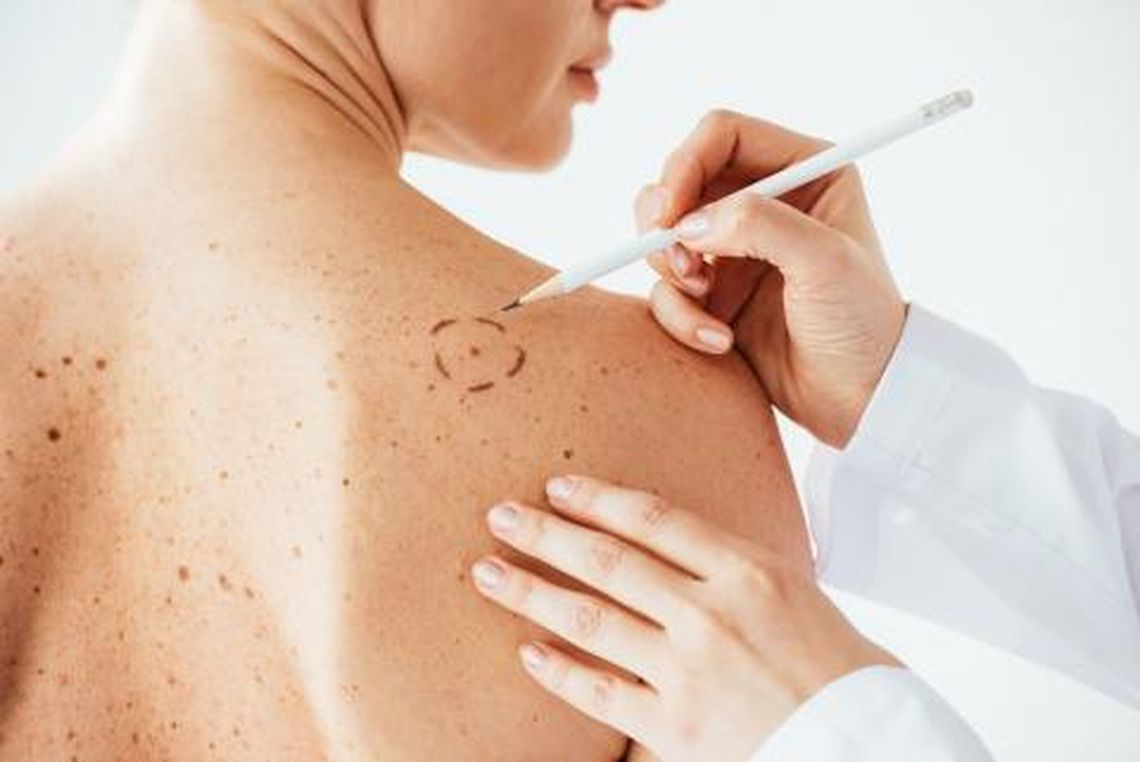 La melanoma es uno de los tipos de cáncer de piel más peligrosos y está en aumento en Latinoamérica.