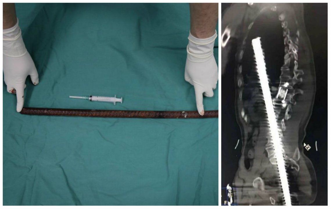 Cayó sobre una viga y quedó empalado: la barra le ingresó por una nalga