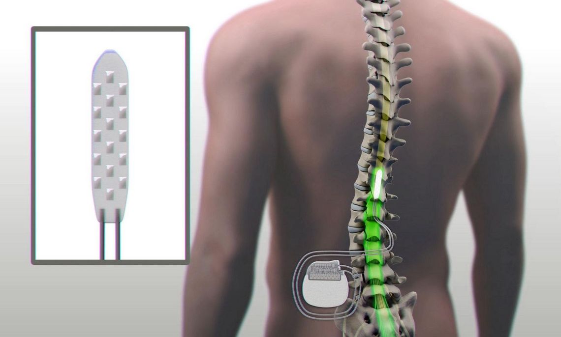 Tres parapléjicos volvieron a caminar gracias la estimulación eléctrica de la médula espinal