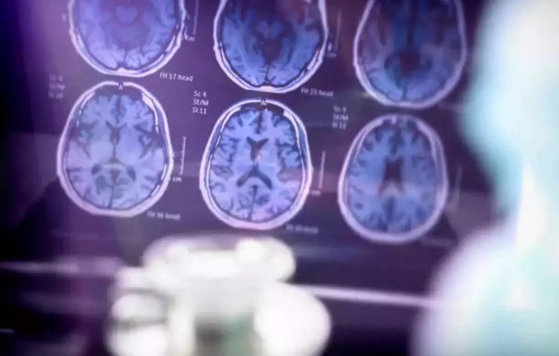 Un nuevo fármaco que se encuentra en Fase 3 en sus ensayos clínicos, abre nuevas expectativas para las personas con Alzheimer