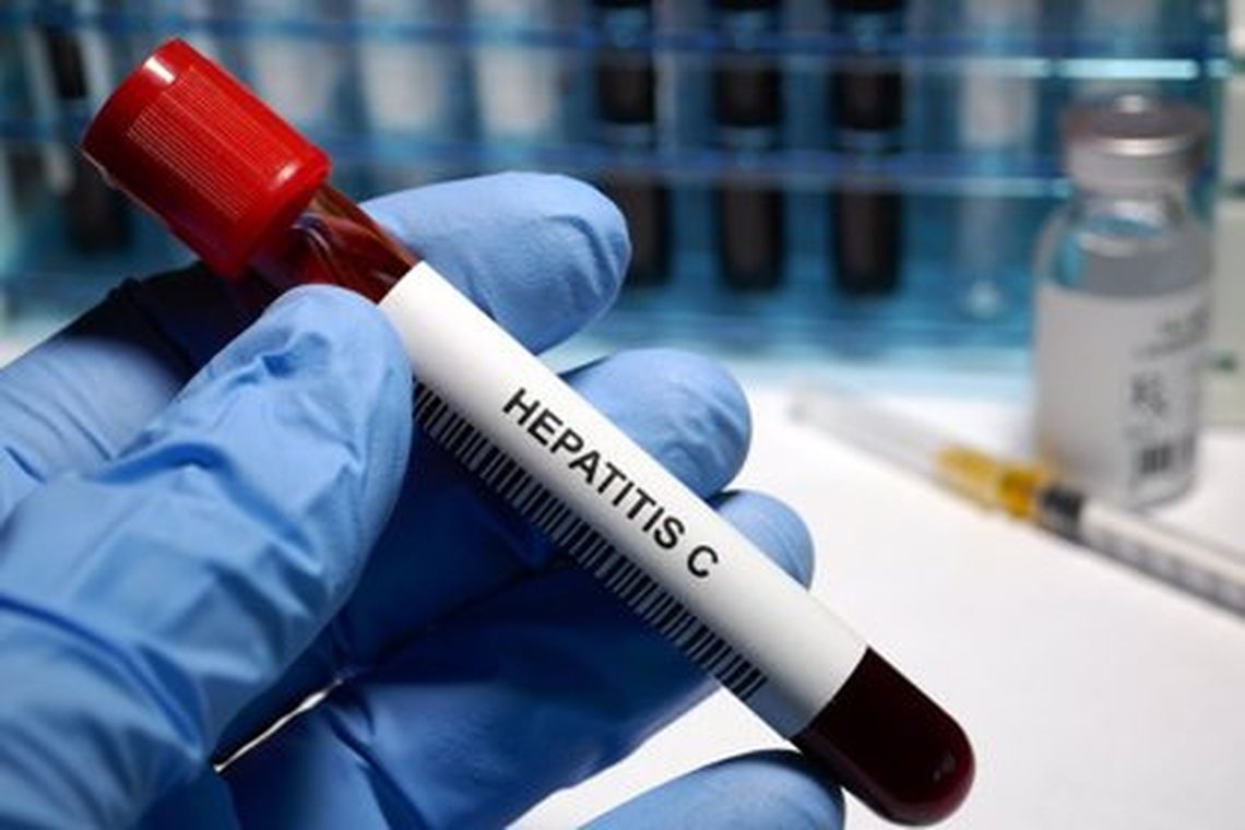 La hepatitis C es una de las causas más comunes de enfermedad hepática crónica en todo el mundo.