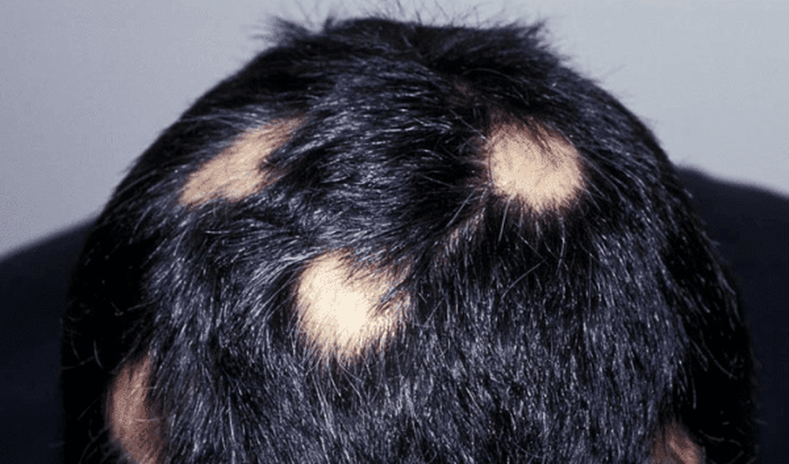 La alopecia afecta a más de 300.000 personas en Estados Unidos.