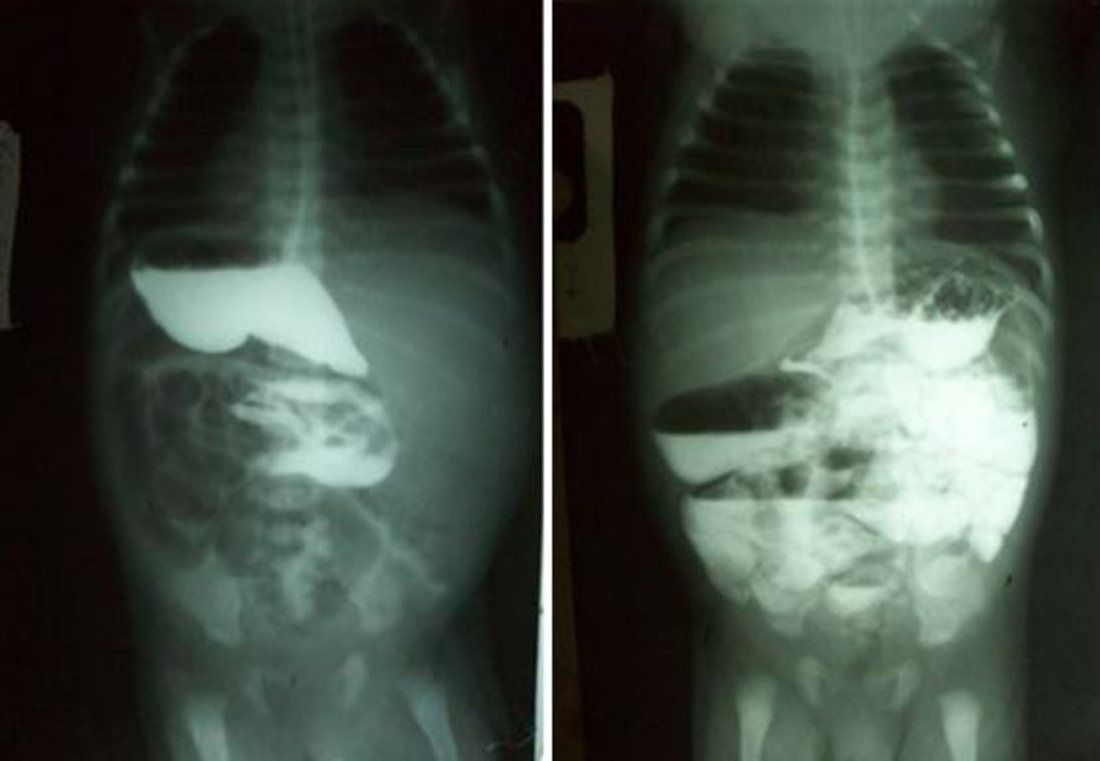 Qué es una brida intestinal y cómo es la operación que le realizaron a Mirtha Legrand