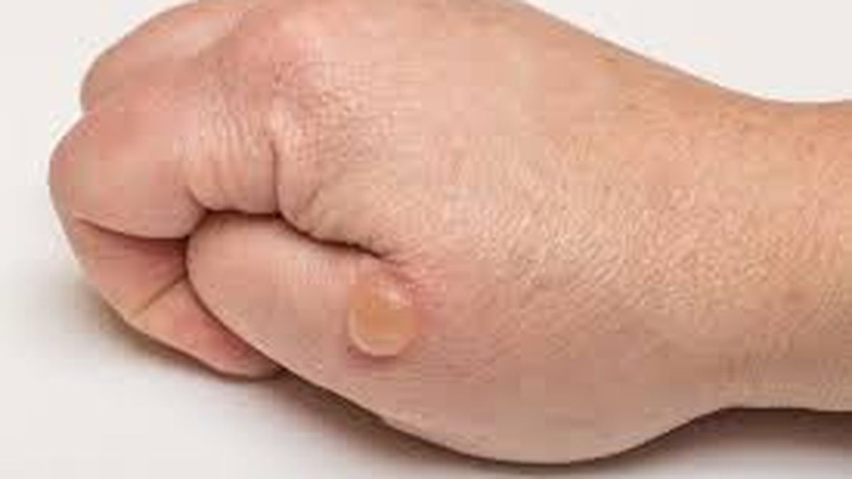 Cuando Te Quemas Es Bueno Reventar La Ampolla www.diariopopular.com.ar