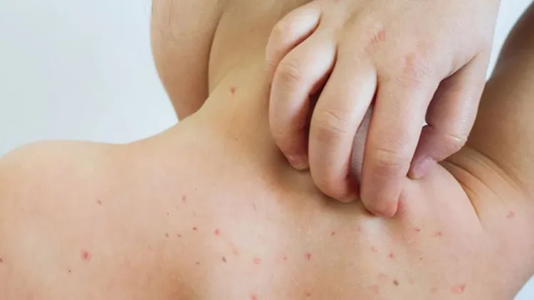 El sarampión se transmite por el aire y afecta sobre todo a personas sin el esquema de vacunación completo.