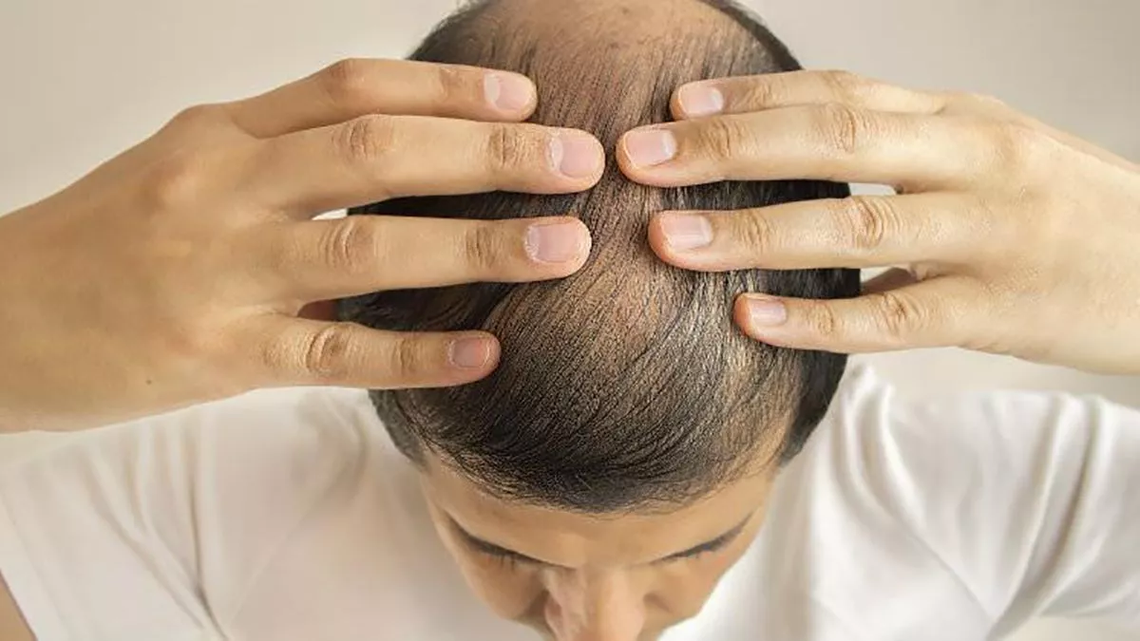La caída del cabello es un fenómeno común tanto en hombres como en mujeres