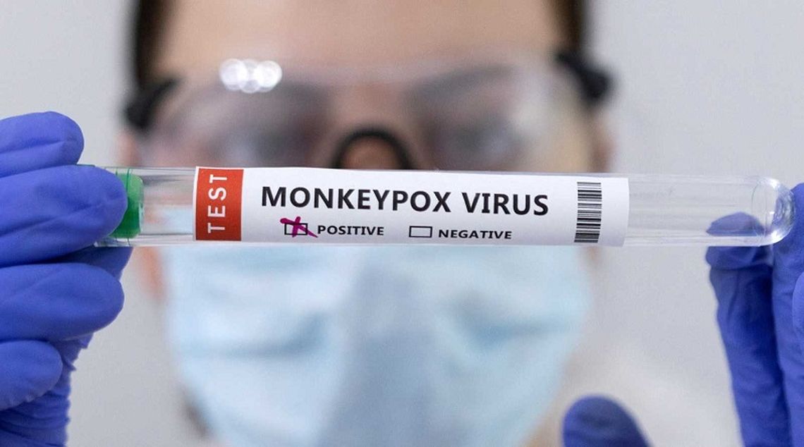 Aumentan los casos de viruela del mono en Nueva York y San Francisco