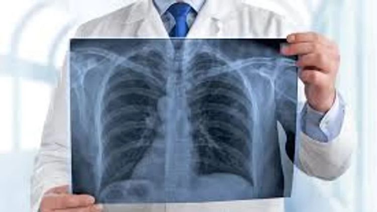 Según la OMS, el cáncer de pulmón provoca entre 1,8 y 2,2 millones de muertes por año en el mundo.