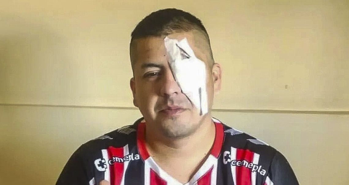 Jonathan Navarro perdió la visión de su ojo izquierdo.