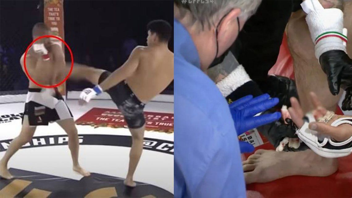 MMA: perdió un dedo tras una fuerte patada de su rival.