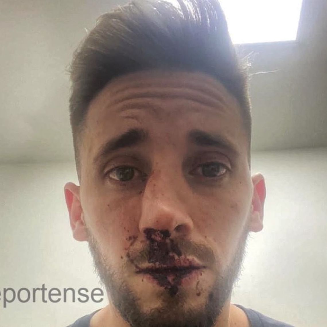 Operaron a Nicolás Morgantini, el defensor de Platense brutalmente agredido