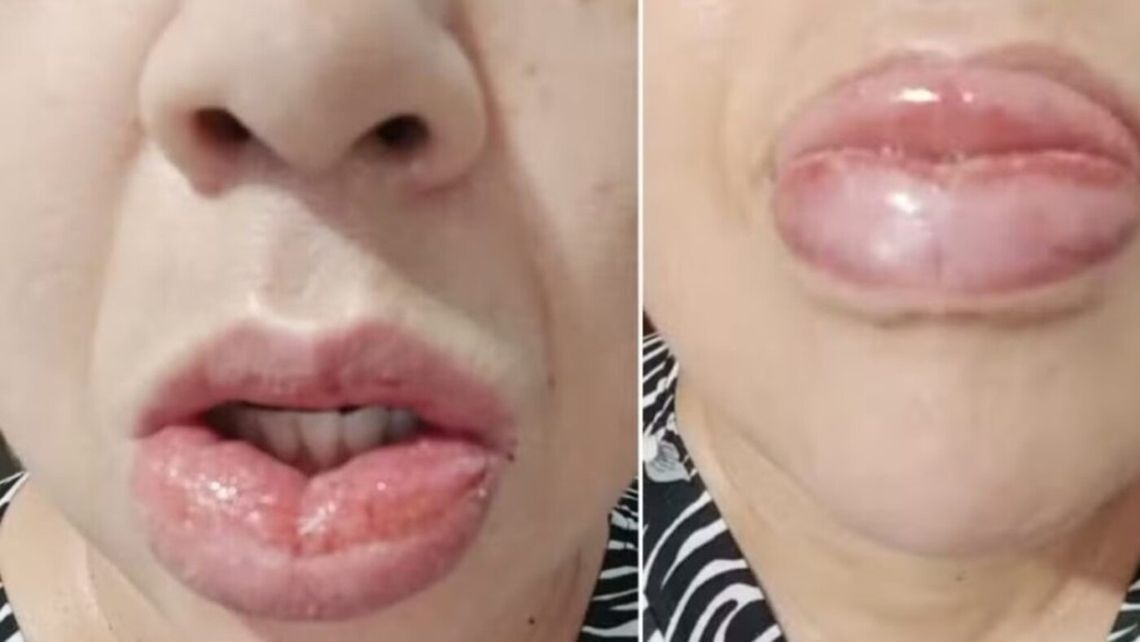 Redes sociales Brasil - Foto de lesiones supuestamente causadas por una pasta dental de Colgate