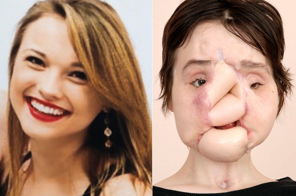 Impactante transformación de la mujer más joven en recibir un trasplante de cara