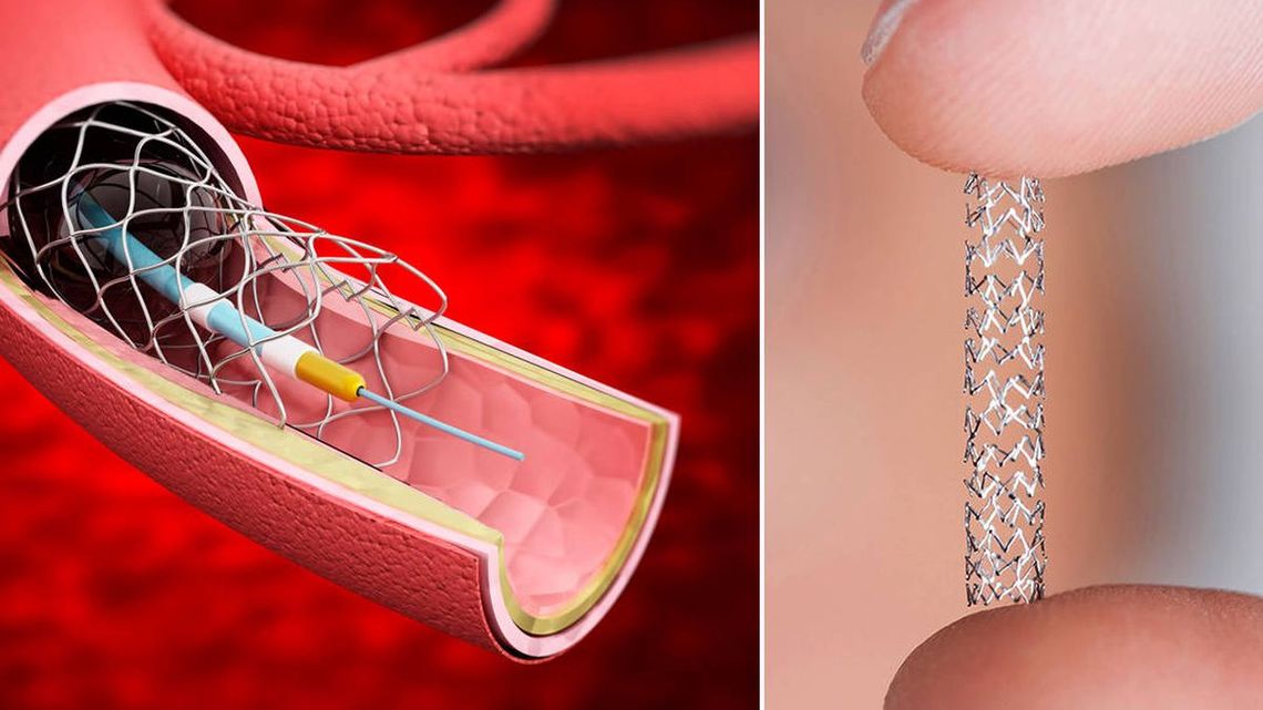 Los stents son los dispositivos que se utilizan en la angioplastia para sostener el flujo sanguíneo obstruido.