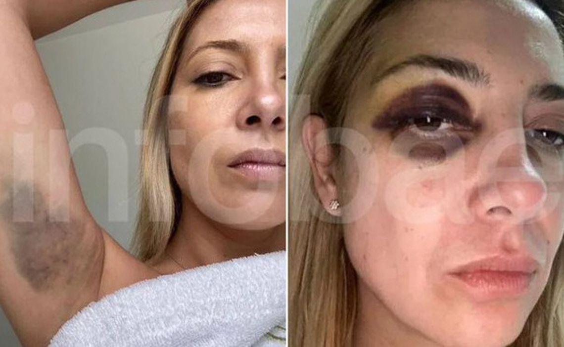 Un gran moretón en un brazo y un ojo en compota: las fotos de Fabiola Yañez que se conocieron tras la denuncia por violencia de género contra Alberto Fernández.