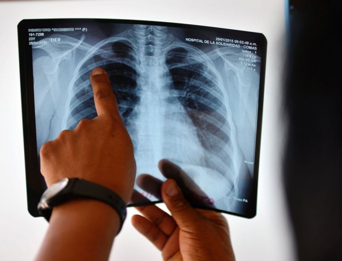 Tuberculosis, un mal que acecha en el Conurbano